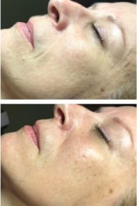 Dermaplaning- the best facial for glowing skin