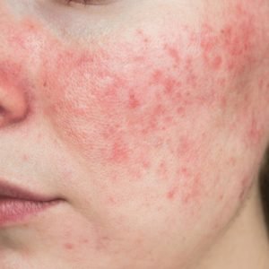 Rosacea causes red bumps on the face and looks like a rash
