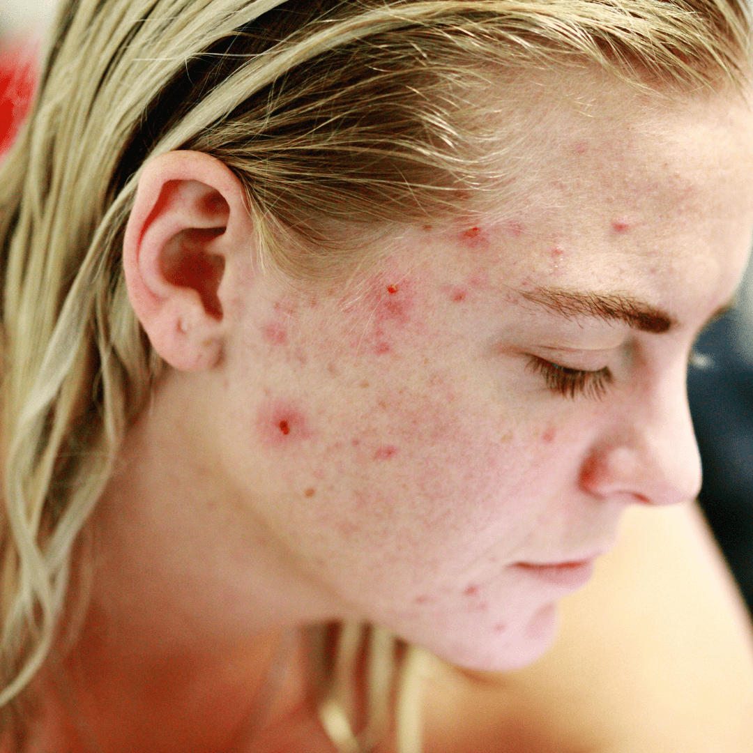 Facials for pimples